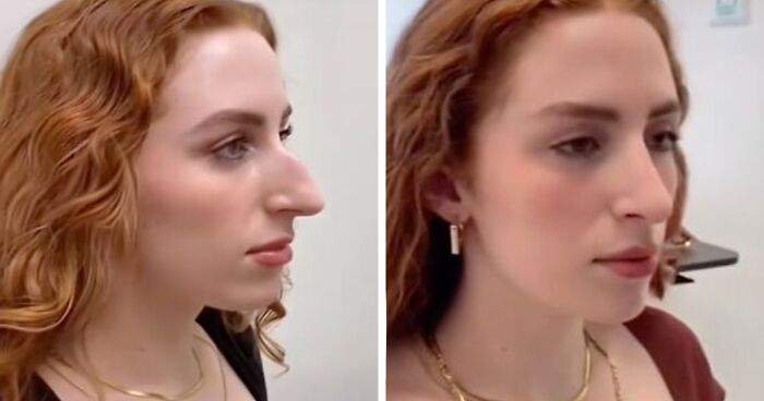People Are Sharing What They Look Like After Plastic Surgery And Here Are 30 Examples
