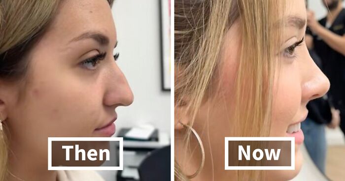 People Are Sharing What They Look Like After Plastic Surgery And Here Are 31 Examples