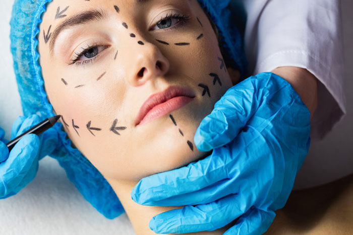 Woman with facial markings for plastic surgery drawn by doctor wearing blue gloves preparing for procedure Woman with facial markings for plastic surgery drawn by doctor wearing blue gloves preparing for procedure