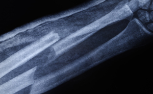 Broken Bone Theory: The TikTok Trend Making Superstition Weirdly Hilarious