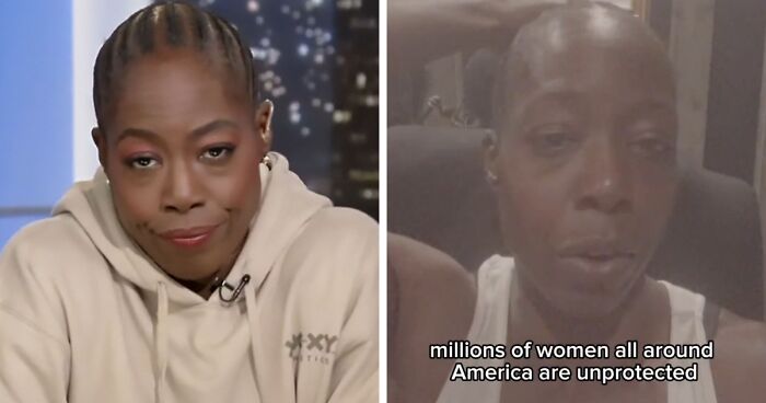 People Are Sharing What They Look Like After Plastic Surgery And Here Are 30 Examples