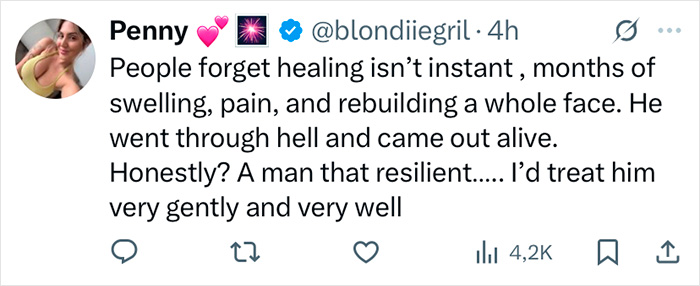 Tweet from Penny discussing Zac Efron's face recovery, mentioning swelling, pain, and resilience in healing process. Tweet from Penny discussing Zac Efron's face recovery, mentioning swelling, pain, and resilience in healing process.