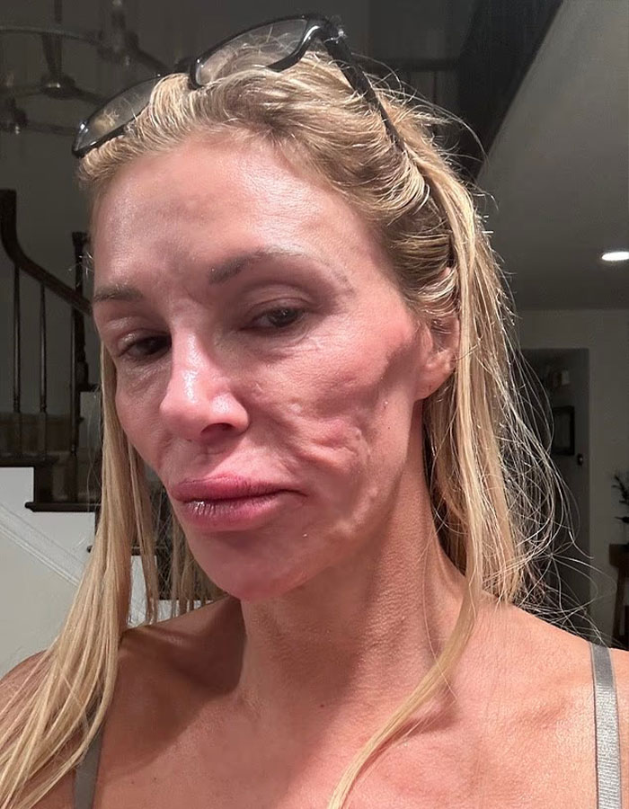 Brandi Glanville close-up showing face disfigurement after diagnosis with natural lighting indoors Brandi Glanville close-up showing face disfigurement after diagnosis with natural lighting indoors