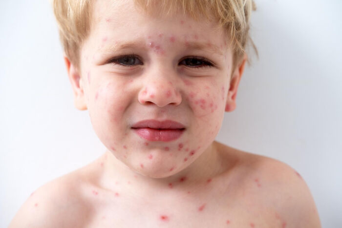 Close-up of a young boy with a rash, illustrating a strange and specific kid's insult as a work of art concept.