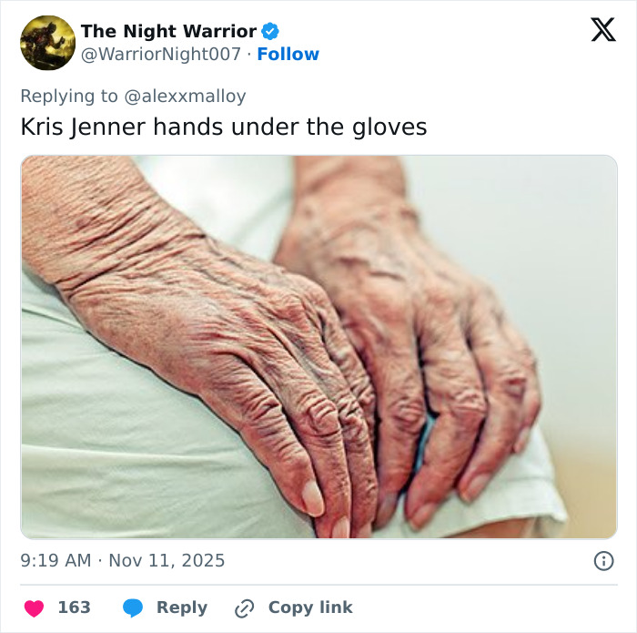 A close-up of aging hands showing wrinkles and veins, highlighting hands after viral $100k facelift reveal. A close-up of aging hands showing wrinkles and veins, highlighting hands after viral $100k facelift reveal.