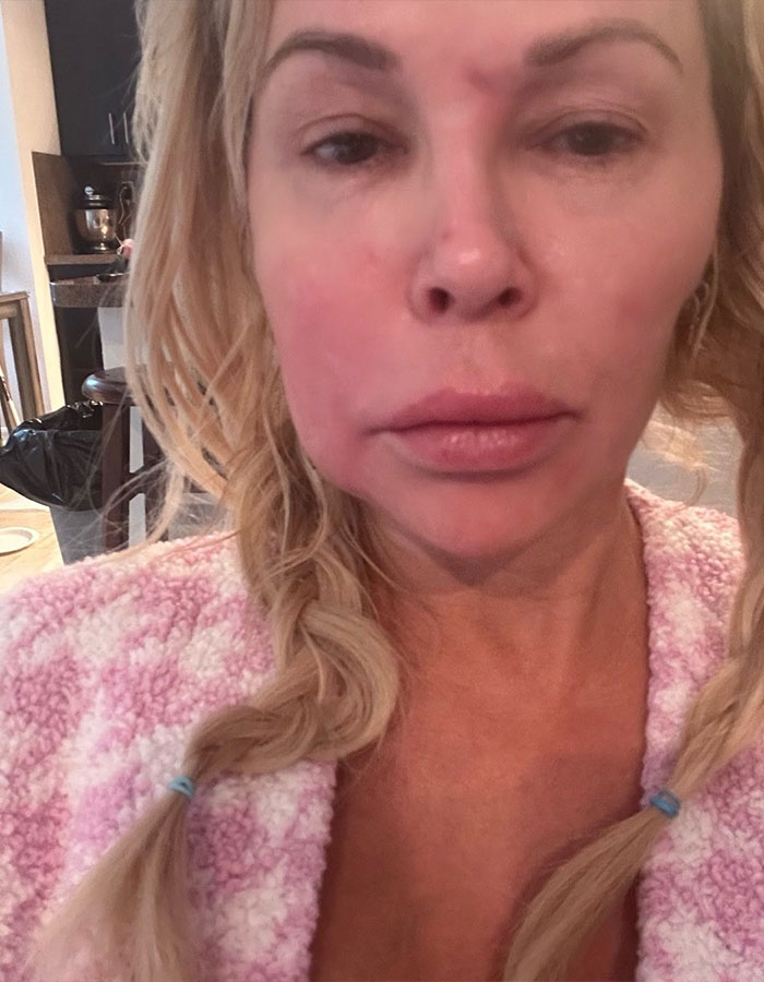 Brandi Glanville showing facial disfigurement after receiving diagnosis following parasite concerns in a casual indoor setting. Brandi Glanville showing facial disfigurement after receiving diagnosis following parasite concerns in a casual indoor setting.