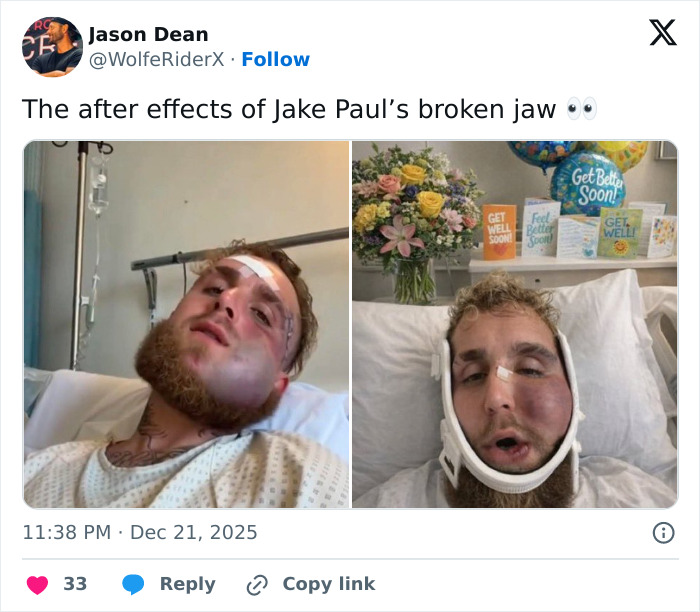 Jake Paul recovering in hospital after broken jaw with visible swelling and medical bandages. Jake Paul recovering in hospital after broken jaw with visible swelling and medical bandages.