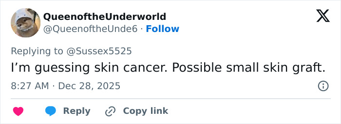 Tweet discussing a possible skin cancer scar and small skin graft in reference to Kate Middleton’s appearance.