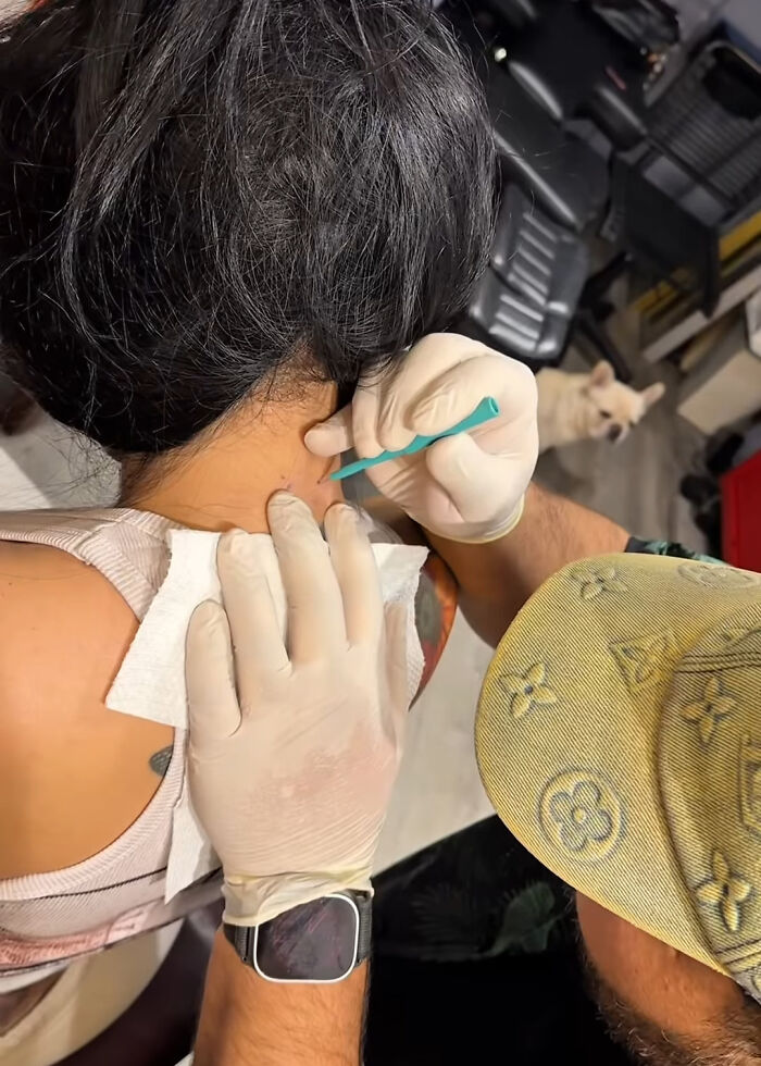 Person receiving neck piercing as part of new set of neck and back piercings with gloved hands performing the procedure. Person receiving neck piercing as part of new set of neck and back piercings with gloved hands performing the procedure.