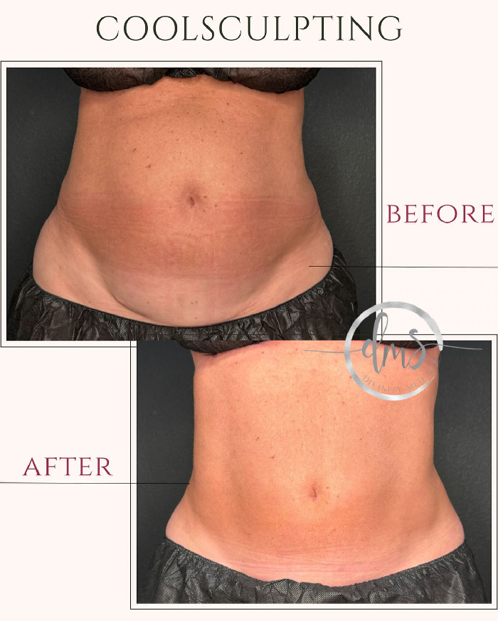 Fotos de antes e depois do Coolsculpting mostrando redução visível da gordura abdominal e textura da pele mais lisa.