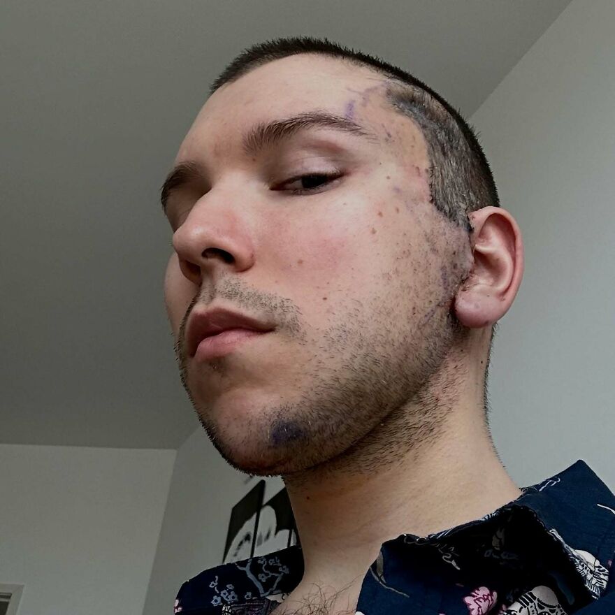 Close-up of a Nikocado Avocado showing cosmetic surgery scars and marks on his face, highlighting Nikocado Avocado cosmetic surgery results. Close-up of a Nikocado Avocado showing cosmetic surgery scars and marks on his face, highlighting Nikocado Avocado cosmetic surgery results.