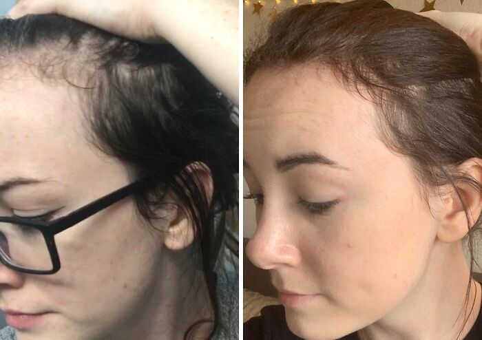  Styling A Precarious Comb-Over To Hide Your Scalp Is Stressful Work That You Can Avoid By Using The Rosemary And Biotin Shampoo For Thinning Hair To Convince Your Follicles To Stick Around A Little Longer