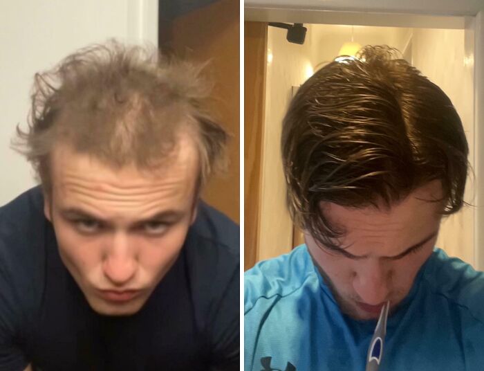 Before and after images showing a man’s hair transformation, illustrating a leap of faith life decision.