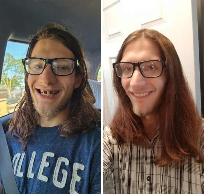 Before and after photos of a young man showing a leap of faith with a confident smile and improved appearance.