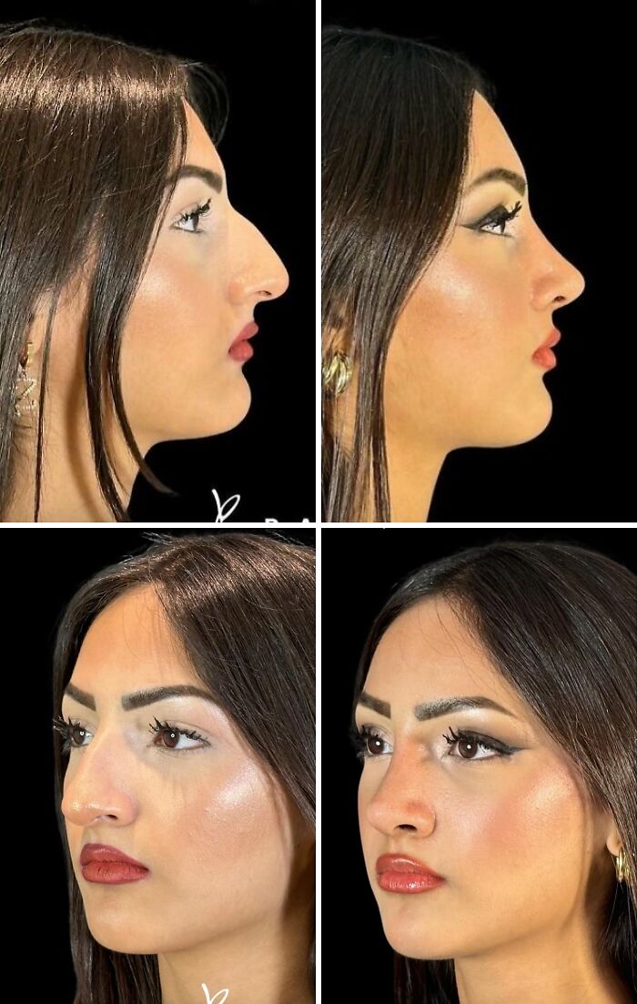 Side-by-side before and after photos showing dramatic cosmetic surgery transformation in Turkey on a young woman.