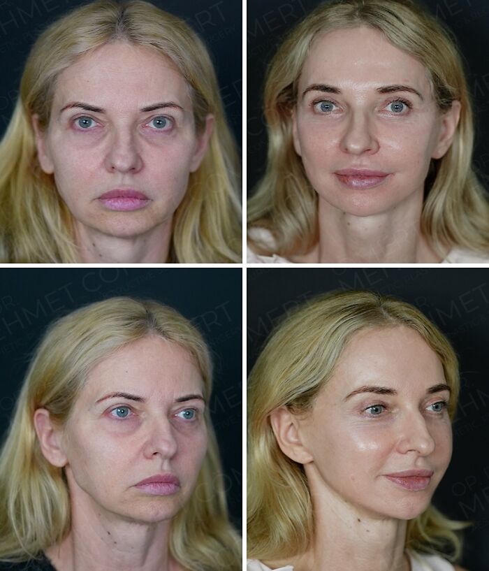 Before and after photos showing dramatic cosmetic surgery transformation in Turkey on a middle-aged woman with blonde hair.