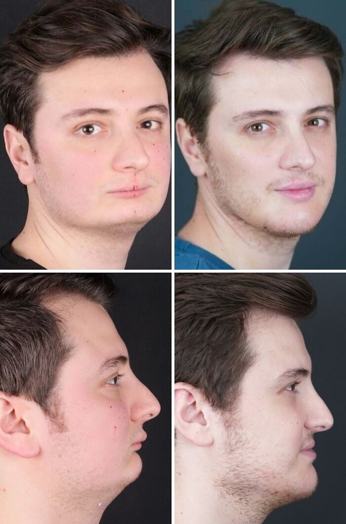 Before and after cosmetic surgery in Turkey showing significant changes in a young man's facial appearance from multiple angles. Before and after cosmetic surgery in Turkey showing significant changes in a young man's facial appearance from multiple angles.