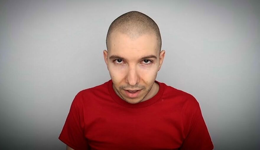 Nikocado Avocado looking at the camera wearing a red shirt after undergoing cosmetic surgery and sharing results.