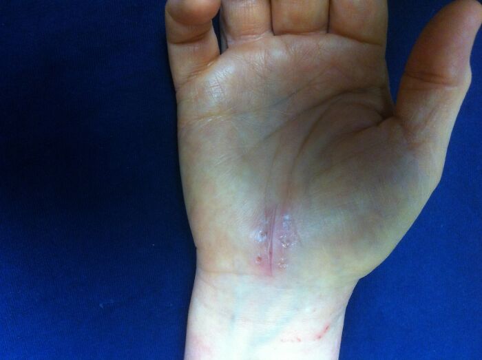 Close-up of a wrist with a healing scar, illustrating one of the true stories that sound completely made up.