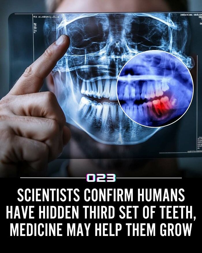 X-ray image of human skull highlighting a hidden third set of teeth with potential medical growth treatment.