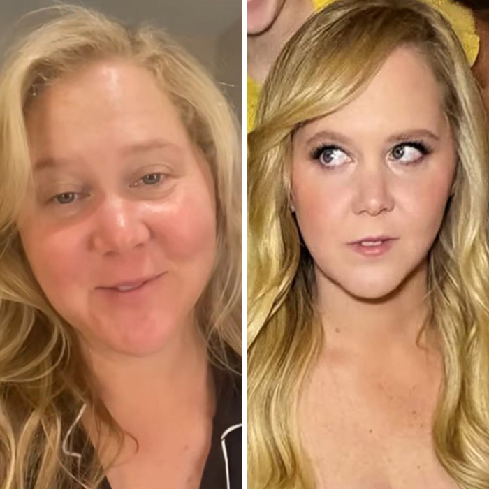 Side-by-side photos of Amy Schumer, focusing on her wrinkle-free appearance from a plastic surgeon’s professional perspective.