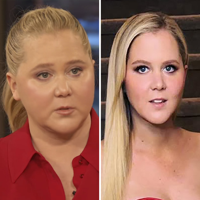 Side-by-side images of Amy Schumer showcasing wrinkle-free skin, discussed from a plastic surgeon professional perspective.