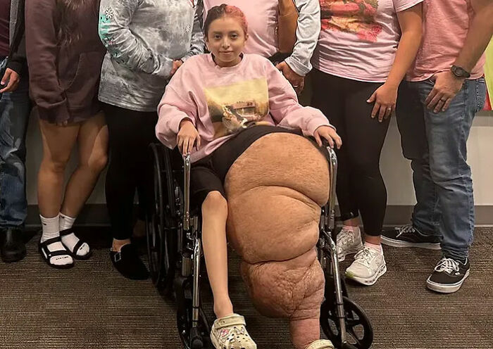 Menina de 14 anos com condição rara passa por 17 horas de cirurgia exaustiva para remover perna de 174 libras Menina de 14 anos com condição rara passa por 17 horas de cirurgia exaustiva para remover perna de 174 libras