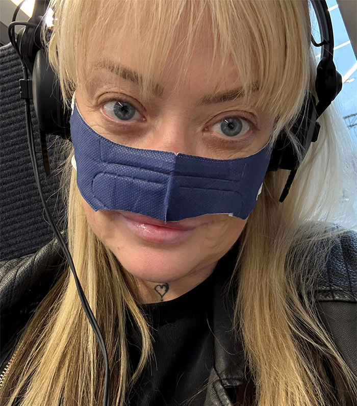 Woman wearing nose support mask and headphones, showing effects after getting veneers in Turkey.