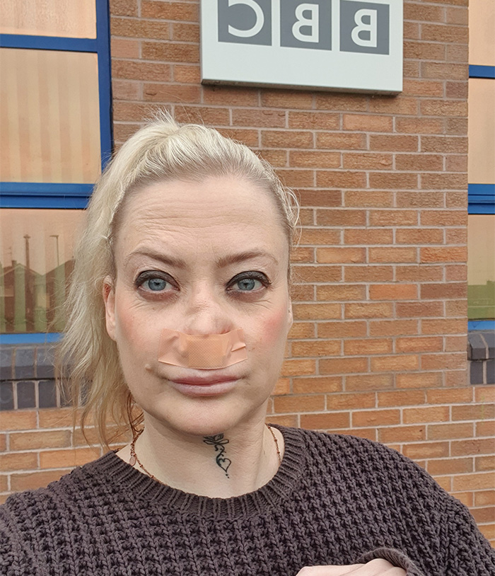 Woman with bandaged nose outside a brick building, sharing her experience after getting veneers in Turkey. Woman with bandaged nose outside a brick building, sharing her experience after getting veneers in Turkey.