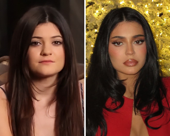 Side-by-side images of a young woman before and after plastic surgery, highlighting risks of surgery in Vietnam.