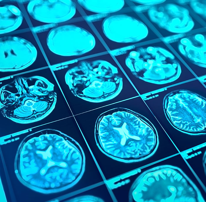 Brain scan images showing detailed cross-sections highlighting areas of low brain activity in a medical context. Brain scan images showing detailed cross-sections highlighting areas of low brain activity in a medical context.