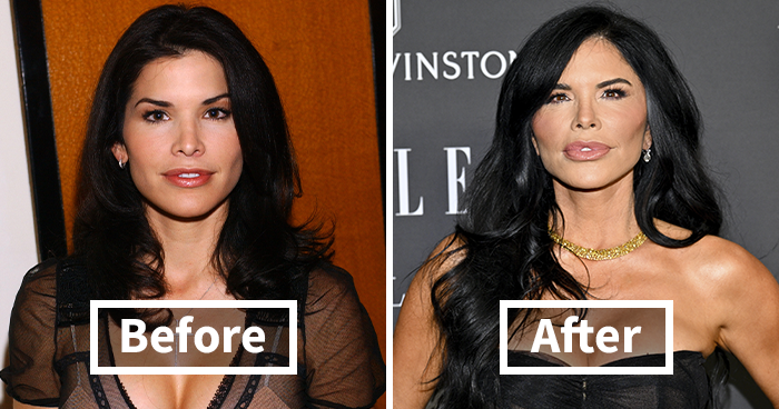 20 Celebrities Who Learned The Hard Way About Plastic Surgery