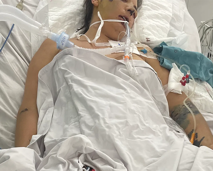 Woman on life support in hospital bed after plastic surgery in Vietnam, connected to breathing and IV tubes. Woman on life support in hospital bed after plastic surgery in Vietnam, connected to breathing and IV tubes.