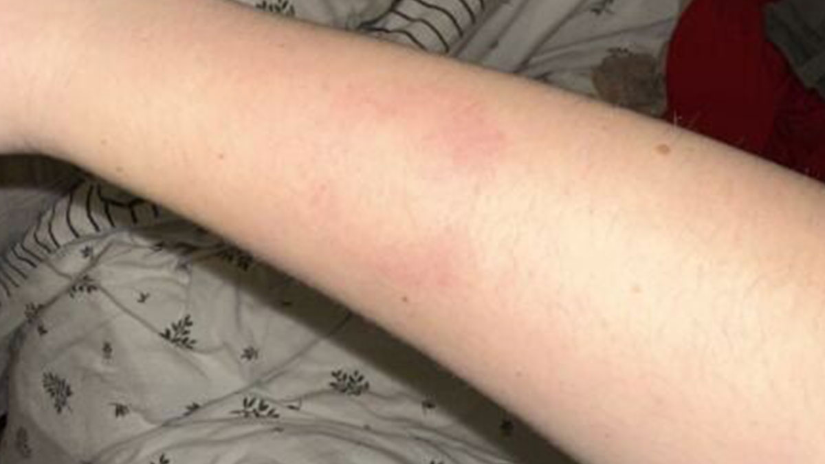 Forearm showing red bite marks and irritation likely caused by a kid during Christmas with a nanny nearby.