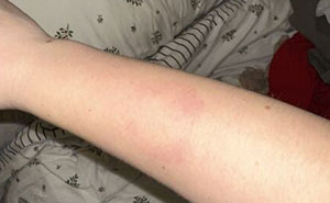 Woman Gets Bitten By Autistic Nephew, Refuses To Babysit After Sis Says She Won’t Discipline Him