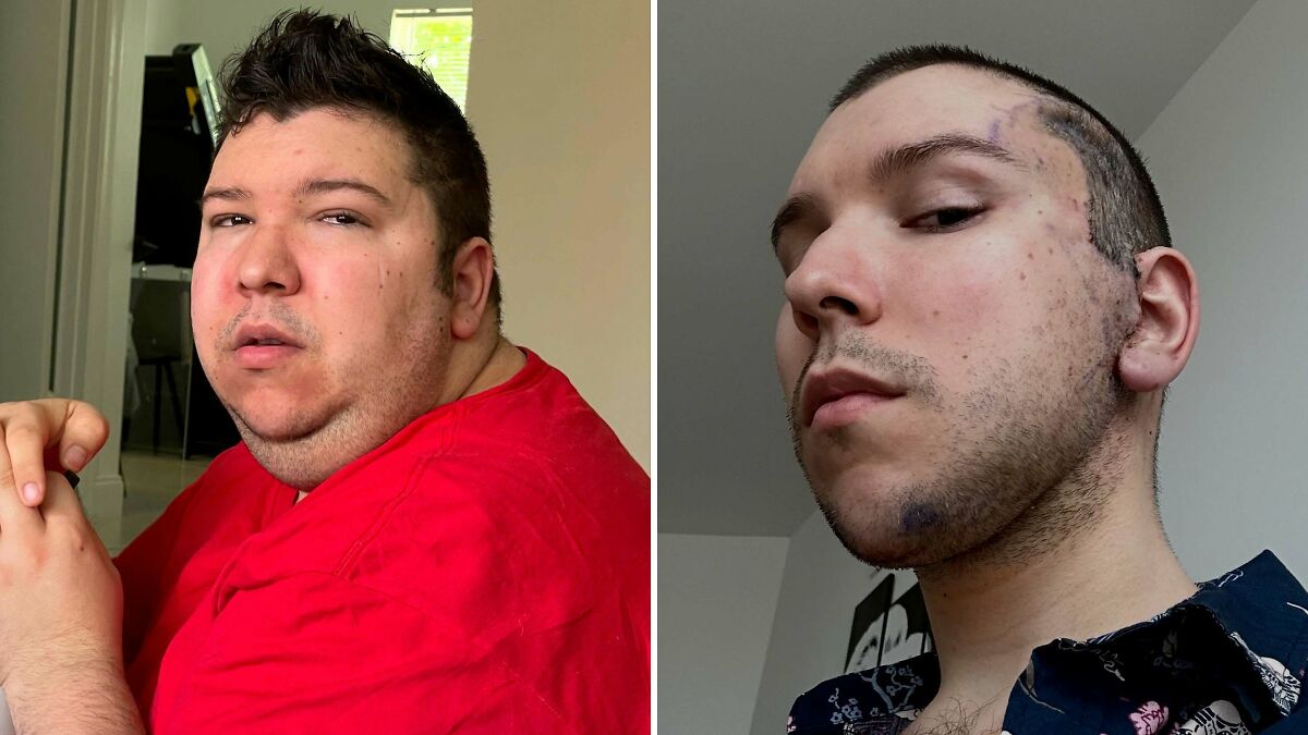 Nikocado Avocado before and after cosmetic surgery, showing transformation and healing progress in two side-by-side photos.