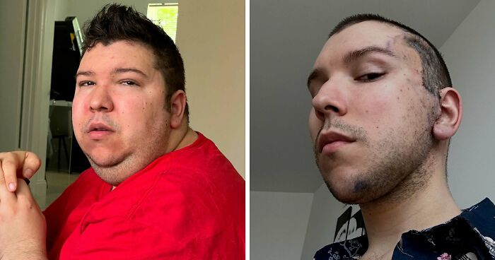 Nikocado Avocado Undergoes Cosmetic Surgery, Shares Results