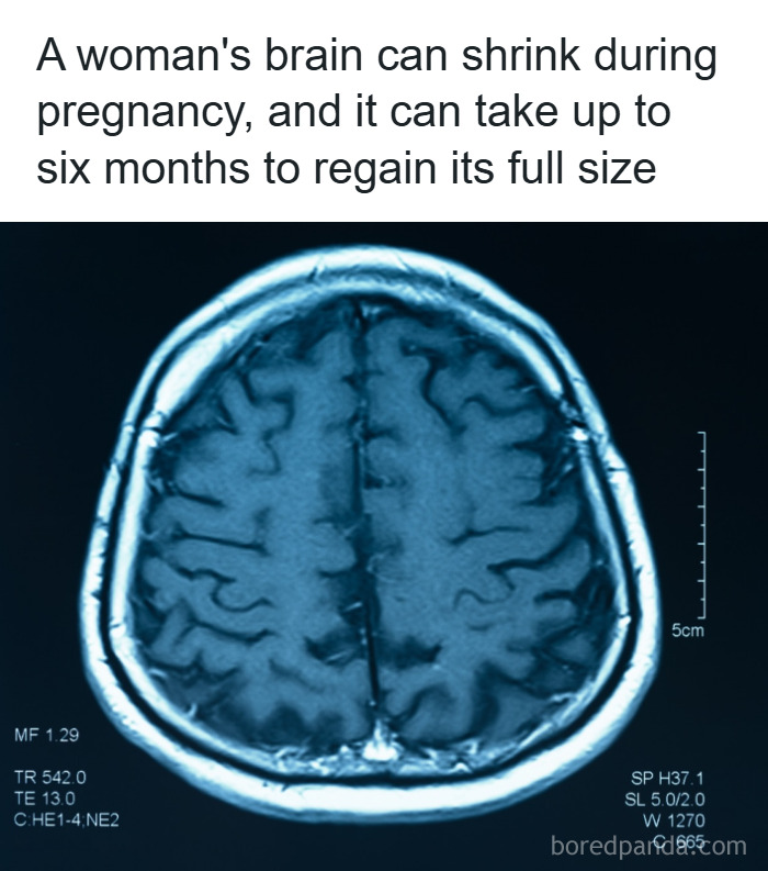 Brain scan showing how a woman's brain can shrink during pregnancy, a fascinating psychology fact about brain changes.