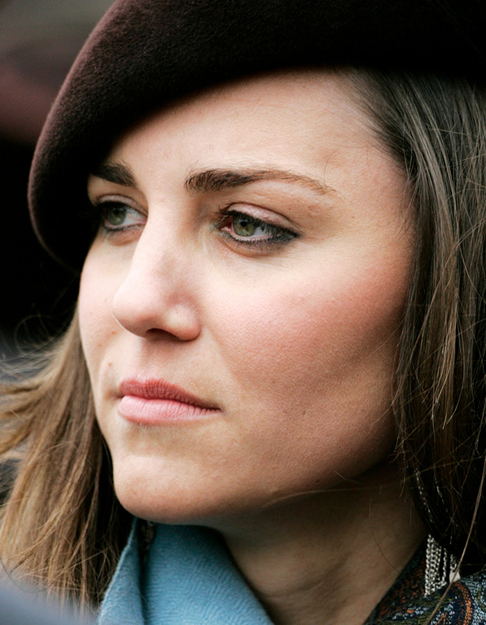 Close-up of Kate Middleton showing a subtle facial scar, fueling rumors about her 2024 hospitalization severity.