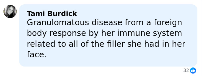 Comment by Tami Burdick explaining granulomatous disease linked to facial filler causing immune response and disfigurement. Comment by Tami Burdick explaining granulomatous disease linked to facial filler causing immune response and disfigurement.