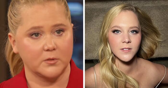 “No Mystery”: Amy Schumer Sets The Record Straight On Her Health And Cosmetic Procedures