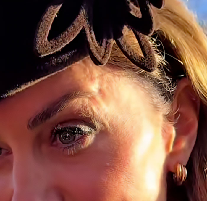 Close-up of Kate Middleton's face showing a skin mark during Christmas appearance fueling cancer scar conspiracy theories. Close-up of Kate Middleton's face showing a skin mark during Christmas appearance fueling cancer scar conspiracy theories.