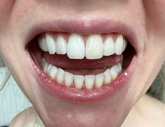 Close-up of a mouth with teeth showing potential damage from common habits wrecking your health long-term.