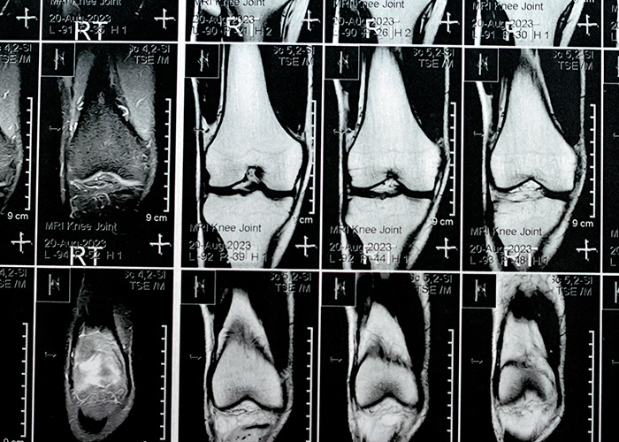MRI scans showing detailed images of knee bone tissue, related to microplastics discovery and expert research responses. MRI scans showing detailed images of knee bone tissue, related to microplastics discovery and expert research responses.