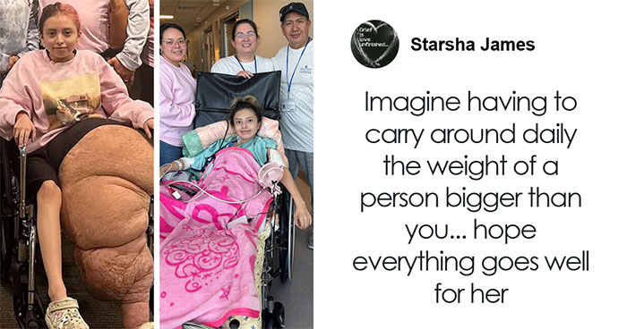 “Why Wasn’t It Removed So Much Sooner?”: Doctors Remove 174lb Leg Off Of 14-Year-Old Girl