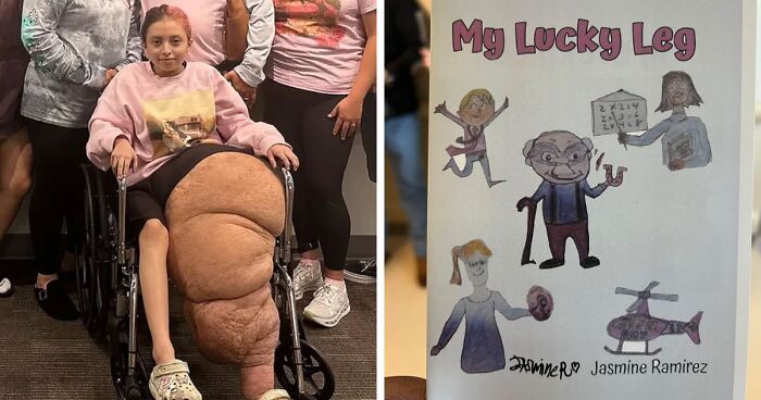 14YO Girl With Rare Condition Undergoes 17 Hours Of Grueling Surgery To Remove 174lb Leg
