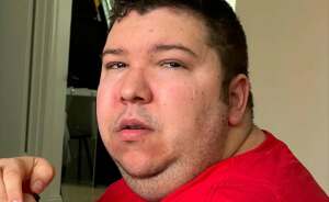 Nikocado Avocado Undergoes Cosmetic Surgery, Shares Results