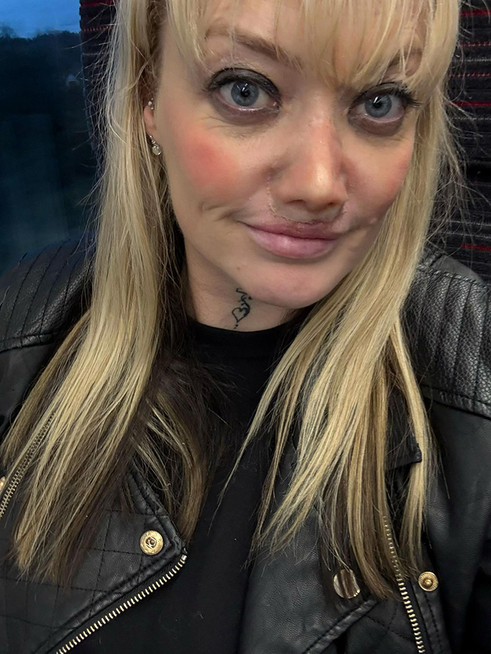 Close-up of a woman with a collapsed nose, showing facial scars and wearing a black leather jacket and blonde hair.