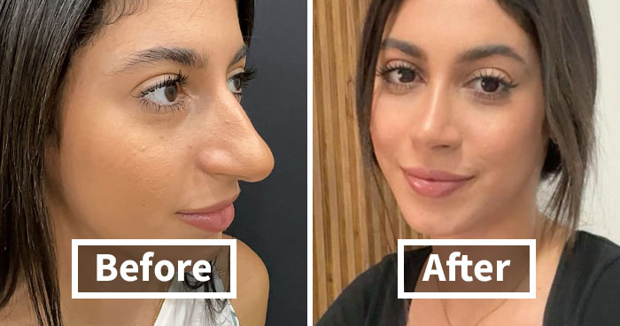67 People Who Became Completely Unrecognizable After Getting Cosmetic Surgery In Turkey