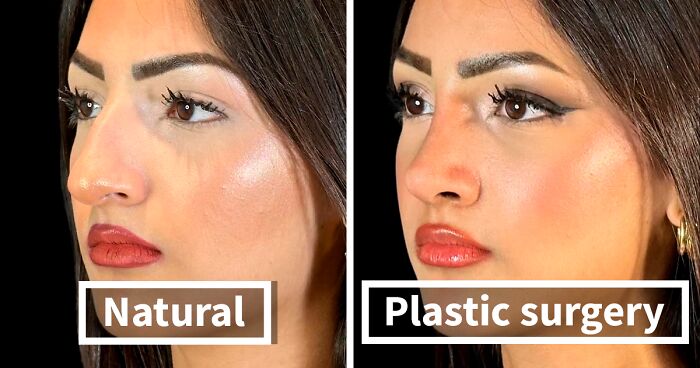 67 People Who Became Completely Unrecognizable After Getting Cosmetic Surgery In Turkey